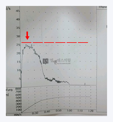 스텐트삽입술 후